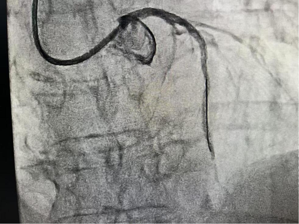遂宁安居区人民医院:IVUS！心血管医生的“第三只眼”！