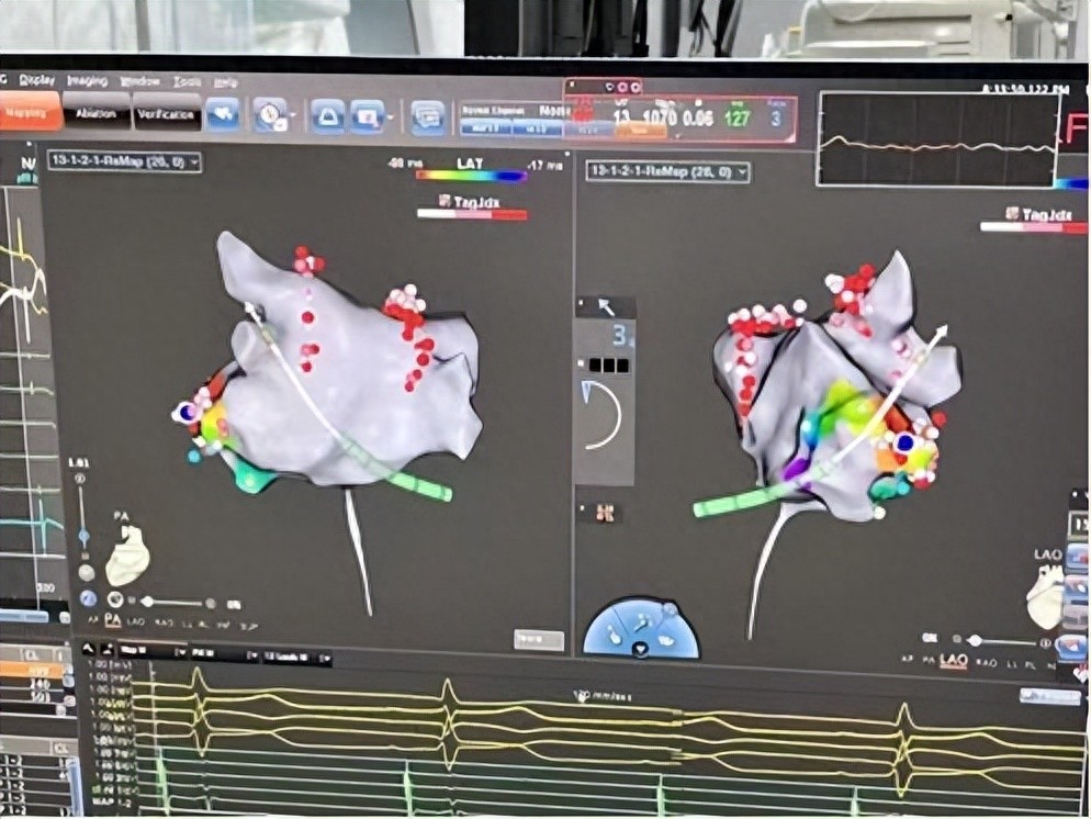 90岁也能做心脏手术？射频消融术打破年龄禁区 让乱跳的心重归平静