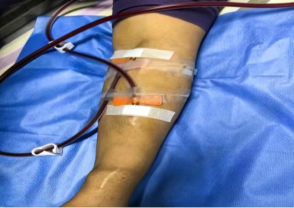 安居区医院：血透室新突破 这种穿刺技术让透析患者少受罪、更安心