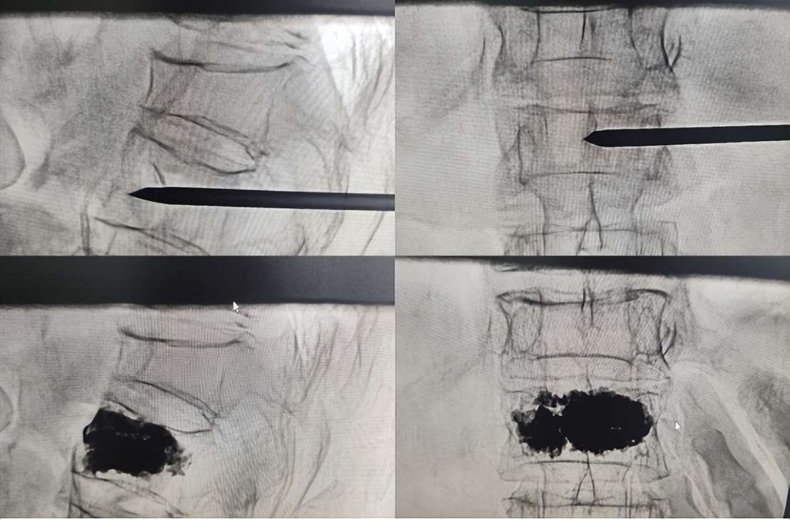 安医骨外科成功开展首例微创椎体成形术 老年骨折患者重获活动能力