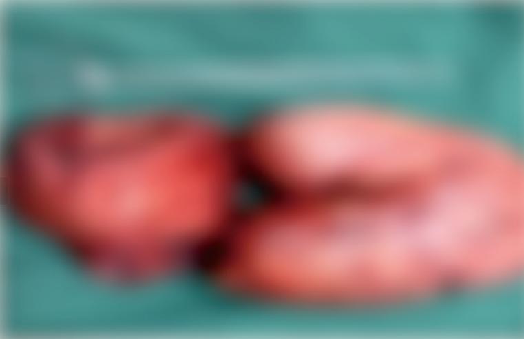 腹部膨隆如鼓！体内竟藏 3.3kg 巨型肿瘤，安医精准拆弹 转危为安！